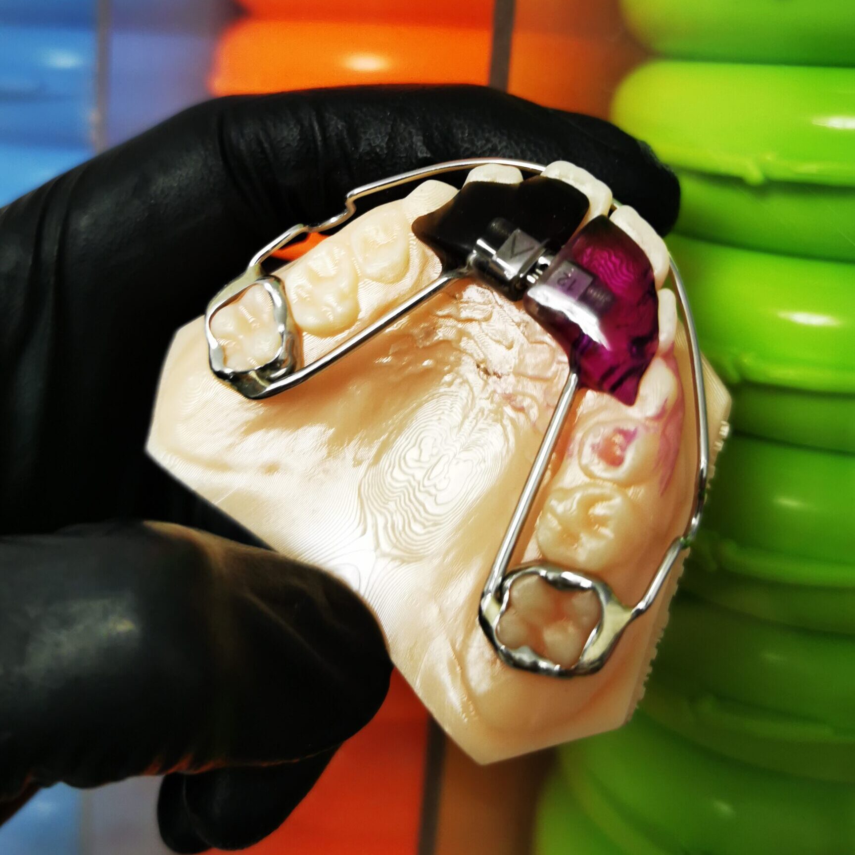 Disjunctor cu surub anterior, bite plate si arc vestibular
